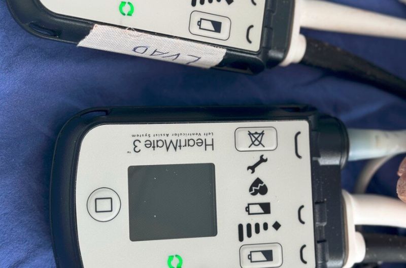 Така на практика мъжът получи изцяло изкуствено сърце