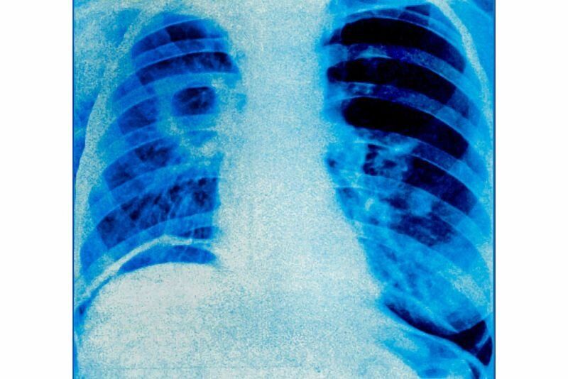 Рентенова снимка на туберкулоза