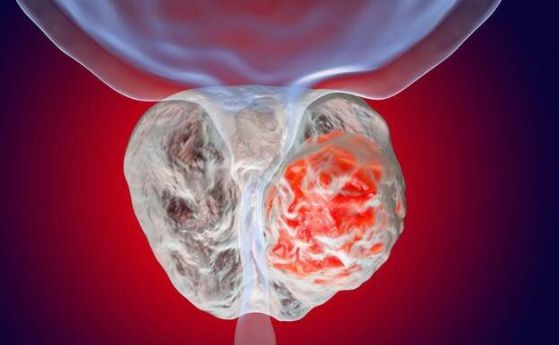 Рак на простатата