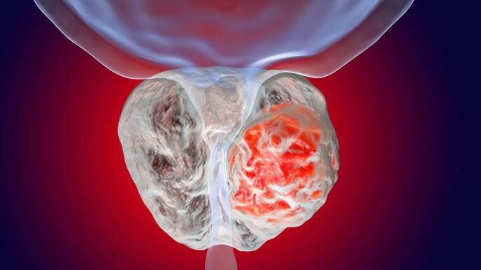 Рак на простатата