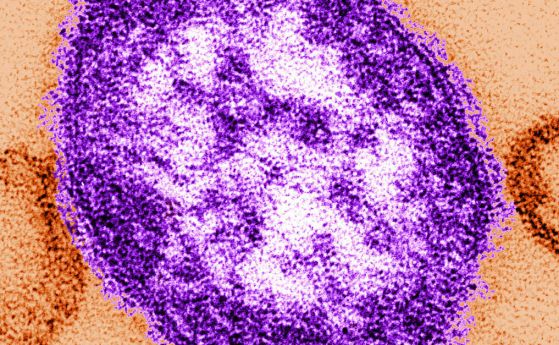 Първи случаи на морбили във Варна