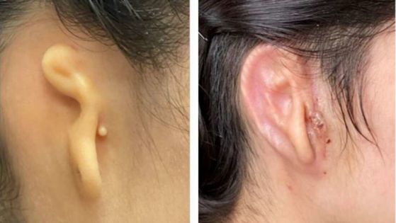 имплант на ухо